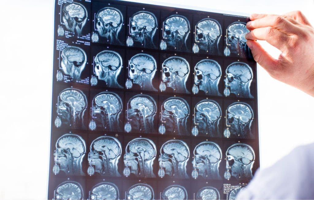 a person holding up an x-ray of a brain scan